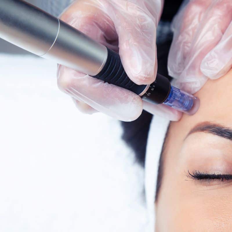 Morpheus8 treatment Maldon from Lipo Sculpt - Book in today!