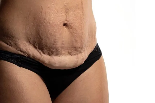 Lost the Weight but Not the Loose Skin? 1 image of womans stomach after weight loss showing loose skin Maldon